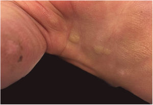 Erythematous brownish plaques on lower limb, topped by blisters at different stages of development (stray blisters, flaccid blisters and exulcerations).