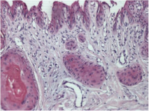 Histopathology (Case 1). Epithelial islets with keratinization of their central portion in variable degree, located in the connective tissue of the nail bed (Hematoxylin & eosin, ×400).