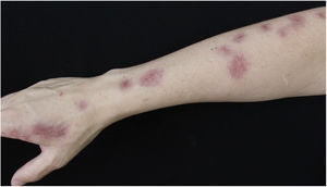 Clinical picture after finishing treatment. Complete regression of lesions.