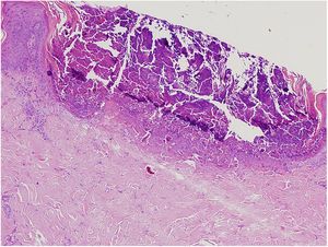 A cup shaped epidermal invagination containing degenerated collagen and elastic fibers with fibrin exudate (Hematoxylin & eosin, ×10).