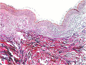 Reduction of elastic fibers in the papillary dermis (van Gieson, x200).