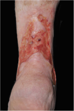 Venous ulcer in the posterior and lateral region of the left lower limb without healing for over 30 years.