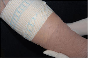 Multilayer elastic compression, performed with a 3 layer system for three months.