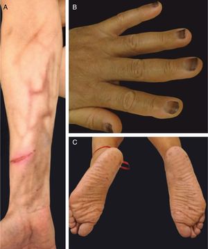 Different hyperpigmentation patterns: (A) serpentine supravenous hyperpigmentation after peripheral chemotherapy infusion (fluorouracil); (B) nail plate pigmentation (daunorubicin); (C) acral lentiginoses (doxorubicin).