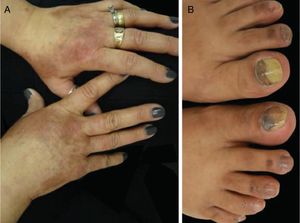 PATEO syndrome (PeriArticular Thenar Erythema and Onycholysis): docetaxel treated patient presenting with (A) erythematous lesions with a distinct distribution to the dorsal aspects of the hands and (B) associated nail changes – subungual hemorrhage and onycholysis.