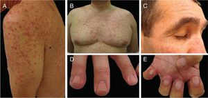EGFR inhibitors related adverse events: (A and B) inflammatory papulopustular rash with associated xerosis (*); (C) trychomegaly and hypertrichosis; (D) periungual fissures and (E) pyogenic granuloma-like lesions. (A, B, D and E on cetuximab treated patients; C on panitumumab treated patient).