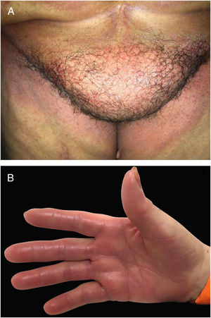 Toxic erythema of chemotherapy (TEC): combination of different lesions caused by direct toxicity of chemotherapy agents with (A) lesions on flexural areas (intertriginous eruption associated with chemotherapy) and (B) on palms and soles (Hand-foot syndrome – HFS).