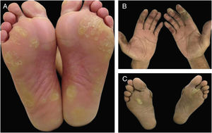 Hand-foot skin reaction (HFSR) associated with antiangiogenic agents (VEGFRi): (A) hyperkeratotic lesions (sorafenib) and (B) bullous lesions (axitinib) on areas of pressure and friction.