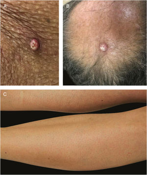 BRAF inhibitor related adverse events: multiple keratoachantomas (A) and low grade squamous cell carcinomas (B) after withdrawal of MEK inhibitor and maintenance of BRAF inhibitor; (C) associated keratosis pilaris-like eruption on the lower limbs.