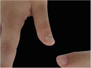 Details from first finger of the right hand from the 7-year-old patient, showing detachment of the previous nail from the newer one.