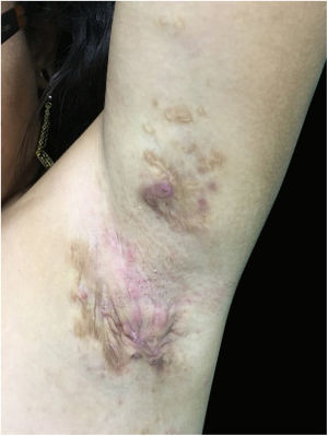 Lesions in the left axilla presenting improvement of the picture after 2 months of use of Adalimumabe SC.