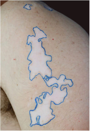 Achromic patches with blaschkoid distribution demarcated on the left arm (24cm2).