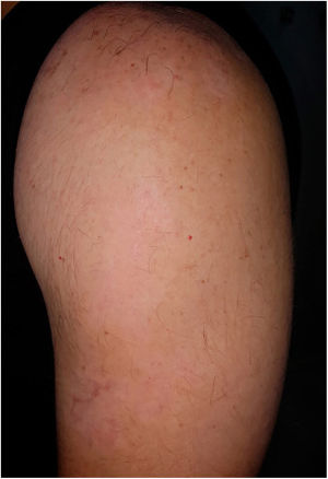 Repigmentation on 95% of recipient site after six months with slight hypochromia.