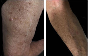 Remission of lesions in right arm (A) and forearm (B).