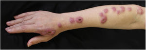 Clinical picture prior to treatment with terbinafine. Nodules approximately 2cm in diameter, discretely erythematous that followed the lymphatic drainage pathway of the right upper limb. In some lesions there was formation of central ulcers.