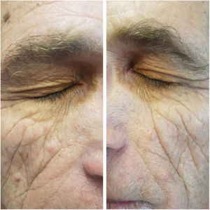Yellowish, well delimited plaques in the region of eyelids bilaterally.
