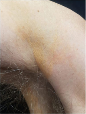 Orange yellow plaque in axillary region.