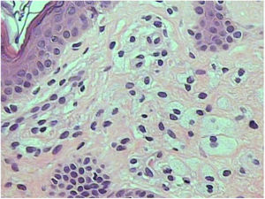 Aggregation of foamy histiocytes in the superficial dermis between collagen fibers.