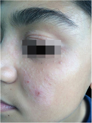 Hypochromic lesion topped by shiny papules.