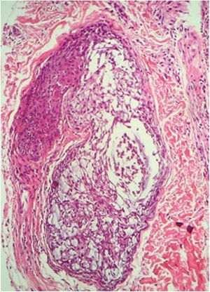 Hair follicles containing fibromyxoid stroma (Hematoxylin & eosin, ×100).