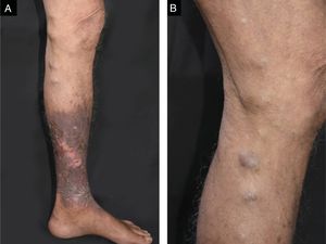 Ulcers with perilesional hardening of the skin, erythema and desquamation were seen on the left leg (A); cord-like, hard, brownish nodular lesions were also observed along the medial aspect of his left thigh and leg at physical examination (B).