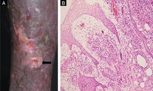 (A) Biopsy site (arrow). (B) Histopathology demonstrated hyperkeratosis and acanhosis, collagen fibroplasia vascular neoformation and diffuse inflammatory infiltrate consisting of lymphocytes, epithelioid cells, giant cells and hemosiderin-laden histiocytes were present in the papilar dermis (Hematoxylin & eosin, ×100).