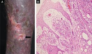 (A) Biopsy site (arrow). (B) Histopathology demonstrated hyperkeratosis and acanhosis, collagen fibroplasia vascular neoformation and diffuse inflammatory infiltrate consisting of lymphocytes, epithelioid cells, giant cells and hemosiderin-laden histiocytes were present in the papilar dermis (Hematoxylin & eosin, ×100).