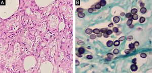 (A) Round structures were seen in reticular dermis (Hematoxylin & eosin, ×200). (B) Grocott