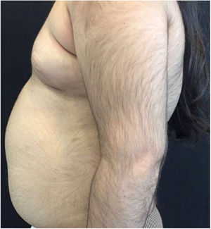 Diffuse growth of thick terminal hairs on upper limb and abdomen.