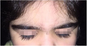Ciliary hypertrichosis (trichomegaly).