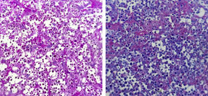 Histopathology. PAS (left) and Alcian blue (right) staining of cryptococci, ×400.