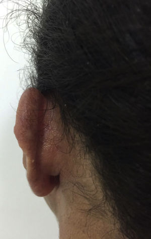 Post-treatment cutaneous lesion.