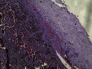 Neoplasm formed by the proliferation of atypical cells containing pigment preferentially infiltrating the meningeal but also the adjacent brain parenchyma, amid areas of necrosis and hemorrhage (Hematoxylin & eosin, ×40).
