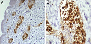 (A) Immunohistochemistry CD68, 200×: positive in the intravascular cells. (B) Detail of (A) (400×).