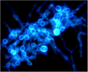 Calcium fluorescent microscopic examination of the smear of colony showed separate branches of mycelium with irregular protrusions, and thick-walled spores of varying sizes after the colony were cultured in PDA medium at 25°C for 14 days (original magnification ×1000).