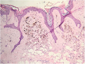 Diffuse proliferation of pigmented epithelioid melanocytic cells in the papillary dermis compatible with intradermal nevus (Hematoxylin & eosin, ×100).