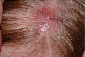 Erythematous plaque with recent onset at the top of a 60 year-old woman.
