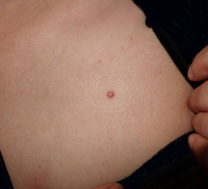 Solitary papule on her chest.
