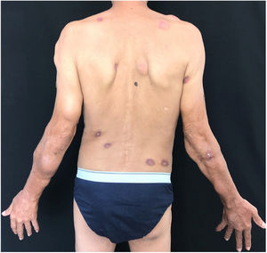 Skin-colored and erythematous nodules and ulcers covered with thick, blackened crusts.