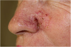 BCC. A poorly delimited lesion measuring 30×30mm compromising the left cheek, lateral nasal wall and nasal ala.