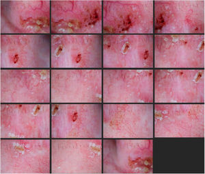 Nineteen overlapped dermoscopic images of the lesion (Heine Delta 20T – HEINE Optotechnik GmbH & Co, Herrsching, Germany) attached to a DSLR camera (polarized, ×10).