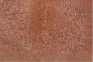 Presence of multiple normochromic nodules associated with diffuse cutaneous infiltration of the dorsum.