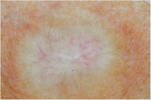 Dermoscopy of the leproma: a yellowish appearance, with a scarring nacreous center and telangiectasias of a centrifugal character. (Contact technique/alcohol immersion).