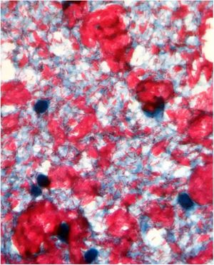 Baciloscopy of earlobe and leproma: bacilloscopic index of 6+ with innumerable bacilli intact.