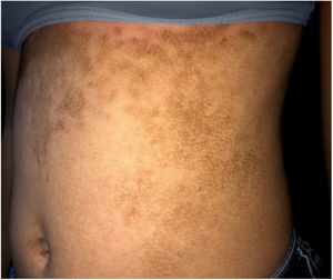 Hyperkeratotic brownish plaques with a dotted pattern affecting the abdomen.