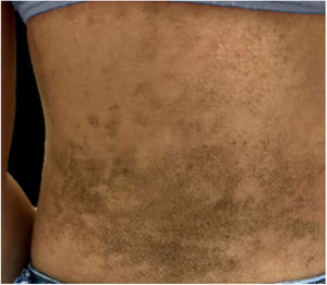 Hyperkeratotic brownish plaques with a dotted pattern affecting the back.