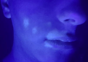 Wood's light examination revealed fluoresce bright blue-white in malar and perioral right regions.