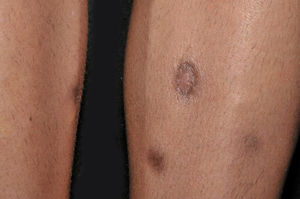 Complete healing of leg lesions after two months with RIPE treatment.