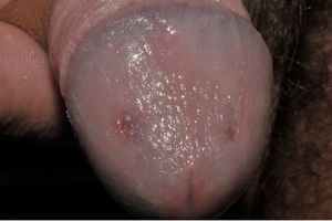 Complete healing of penile lesions after two months with RIPE treatment.