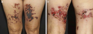 Retiform purpura in a patient with Propylthiouracil (PTU)-induced antineutrophil cytoplasmic antibody (ANCA)-associated vasculitis: (a) Palpable purpura in a livedoid, reticulate pattern with a necrotic center located in the tighs. The recognition of a retiform purpura pattern indicates that a medium vessel component of vasculitis exists, (b) Large ulcerations with irregular borders, granulating wound bed, areas of necrosis and eschar, and serous discharge.